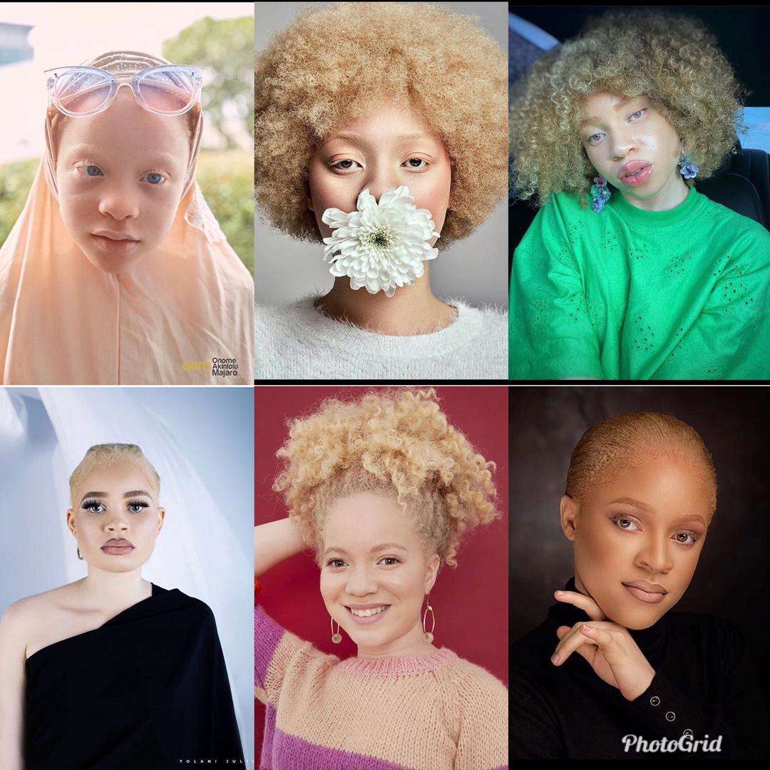 Albinism